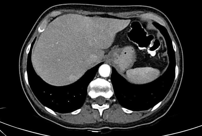 File:Carcinoid mesenteric tumor complicated by chylous ascites (Radiopaedia 76312-88926 A 11).jpg