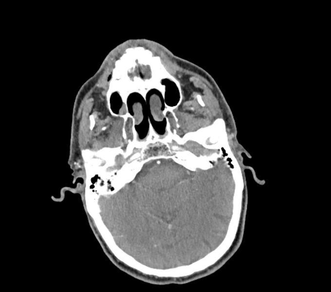 File:Carotid artery pseudoaneurysm (Radiopaedia 84030-99259 C 7).jpg