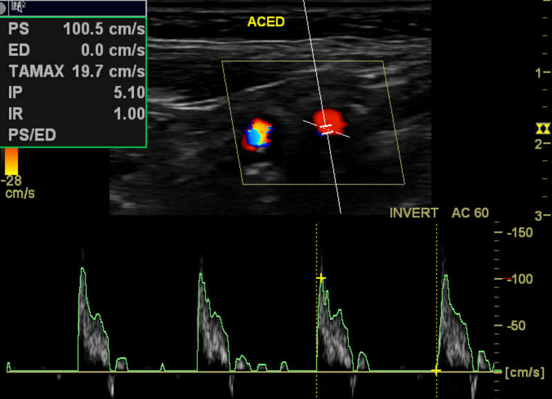 File:Carotid artery stenosis (Radiopaedia 28786-29088 Oblique 1).png