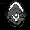 Carotid body tumor (Radiopaedia 20564-20462 Axial non-contrast 1).jpg