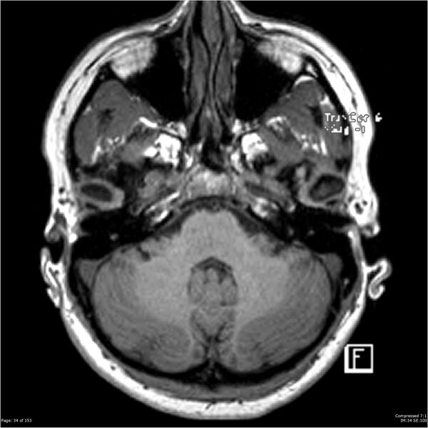 File:Cavernous malformation (cavernous angioma or cavernoma) (Radiopaedia 36675-38237 Axial T1 23).jpg