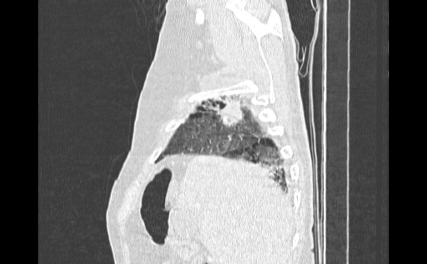 Cavitating bronchogenic carcinoma (Radiopaedia 44489-48162 Sagittal lung window 2).jpg
