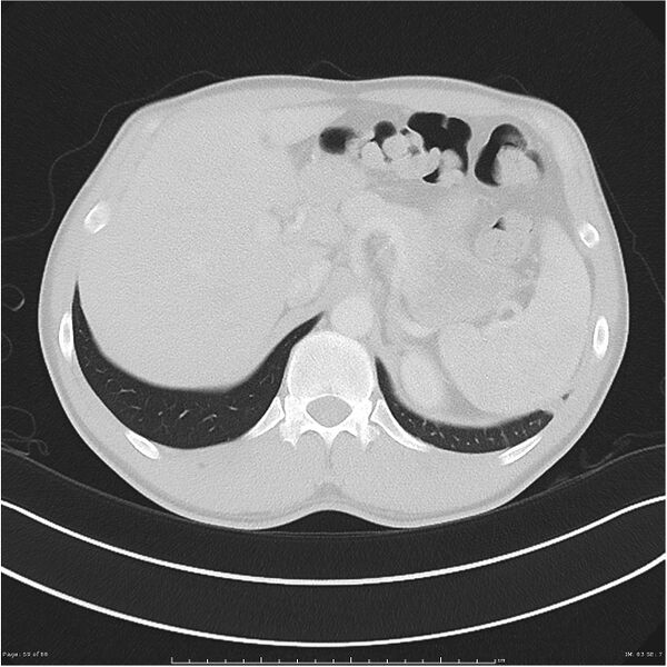 File:Cavitating lung cancer (Radiopaedia 25796-25945 Axial lung window 59).jpg