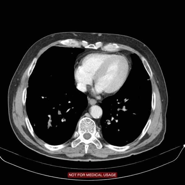 File:Cavitating pulmonary metastases (Radiopaedia 24920-25184 B 20).jpg