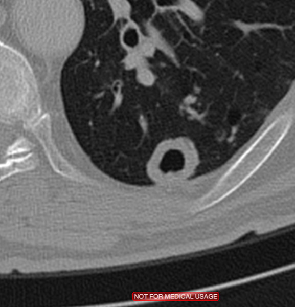 File:Cavitating pulmonary metastases (Radiopaedia 24920-25187 Zoom on axial plane 1).png
