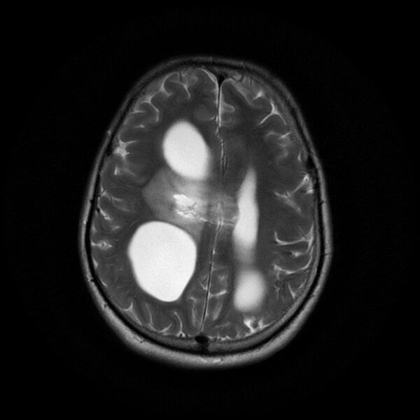 File:Central neurocytoma (Radiopaedia 67618-77021 Axial T2 18).jpg
