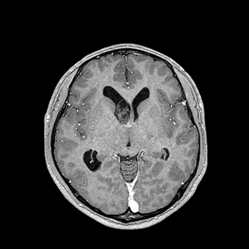 Central neurocytoma (Radiopaedia 79320-92380 Axial T1 C+ 119).jpg