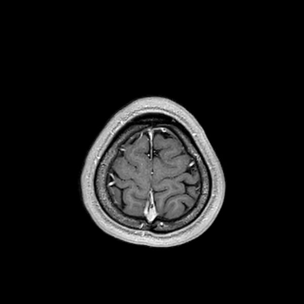 File:Central neurocytoma (Radiopaedia 79320-92380 Axial T1 C+ 210).jpg