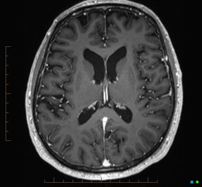File:Cerebellar gangliocytoma (Radiopaedia 65377-74422 Axial T1 C+ 75).jpg
