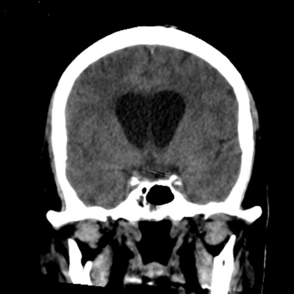 File:Cerebellar hemorrhage causing obstructive hydrocephalus (Radiopaedia 33989-35207 Coronal non-contrast 23).jpg