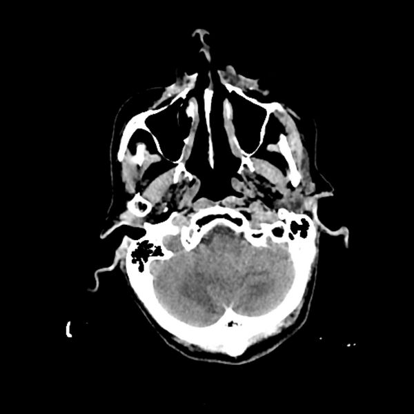 File:Cerebellar metastasis - lung tumor (Radiopaedia 69317-79145 Axial non-contrast 4).jpg