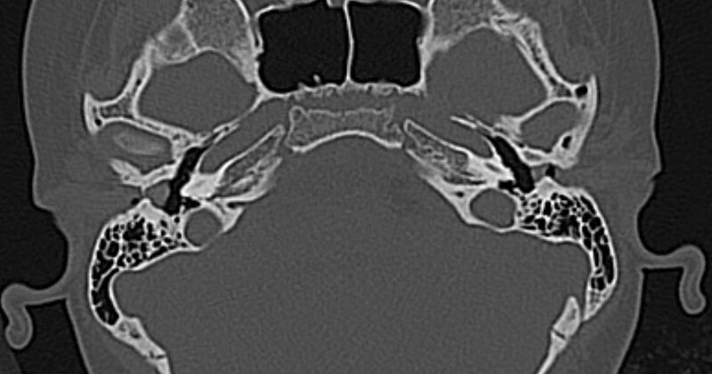 File:Cerebellopontine angle lipoma (Radiopaedia 57303-64242 Axial bone window 19).jpg