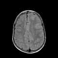 Cerebral abscess post cardiac surgery (Radiopaedia 27244-27420 Axial FLAIR 18).jpg