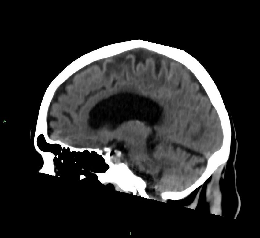 Cerebral amyloid angiopathy-associated lobar intracerebral hemorrhage (Radiopaedia 58376-65513 C 34).jpg