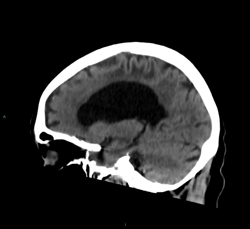 Cerebral amyloid angiopathy-associated lobar intracerebral hemorrhage (Radiopaedia 58376-65513 C 44).jpg