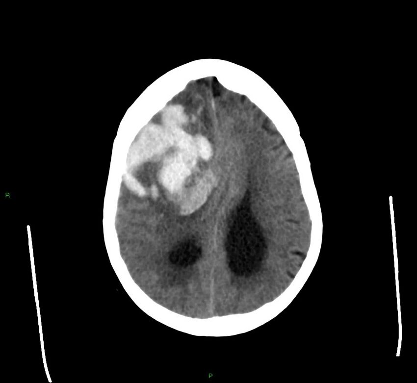 Cerebral amyloid angiopathy-associated lobar intracerebral hemorrhage (Radiopaedia 58560-65723 Axial non-contrast 17).jpg