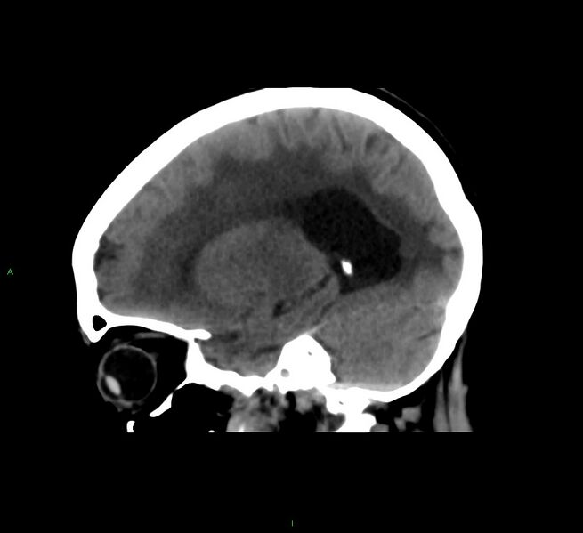 File:Cerebral amyloid angiopathy-associated lobar intracerebral hemorrhage (Radiopaedia 58561-65724 C 17).jpg