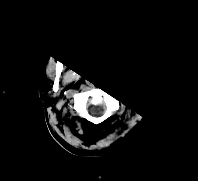 File:Cerebral amyloid angiopathy-associated lobar intracerebral hemorrhage (Radiopaedia 58566-65730 Axial non-contrast 49).jpg