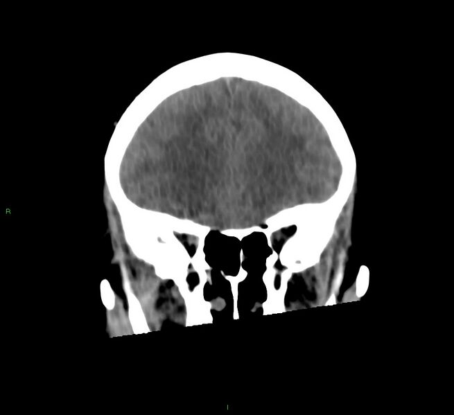 File:Cerebral amyloid angiopathy-associated lobar intracerebral hemorrhage (Radiopaedia 58566-65730 Coronal non-contrast 51).jpg