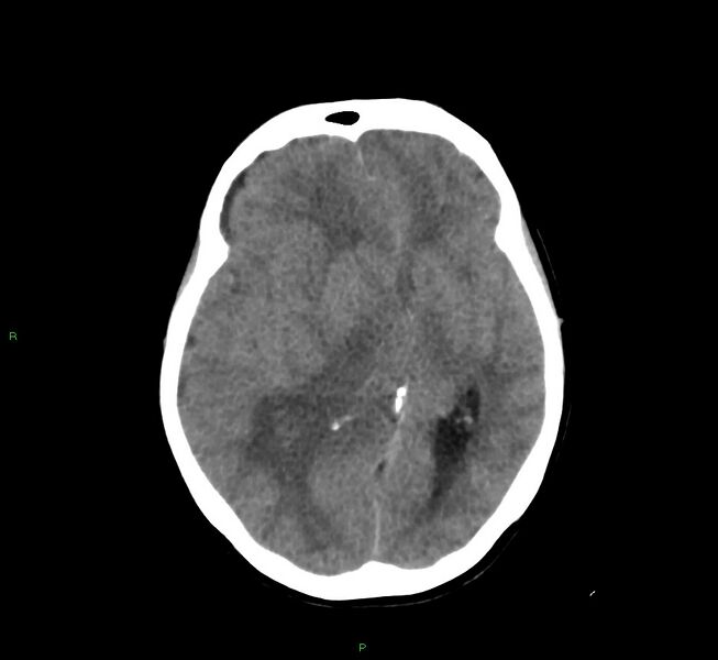 File:Cerebral amyloid angiopathy-associated lobar intracerebral hemorrhage (Radiopaedia 58751-65972 Axial non-contrast 28).jpg