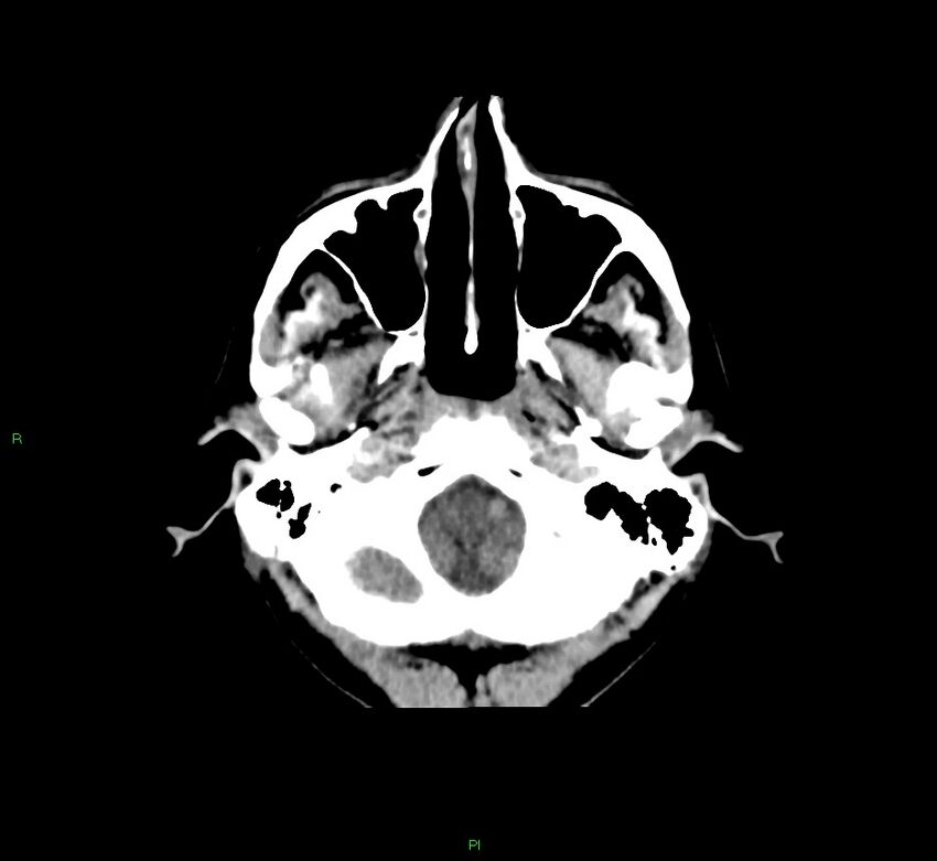 Cerebral amyloid angiopathy-associated lobar intracerebral hemorrhage (Radiopaedia 58756-65977 Axial non-contrast 47).jpg