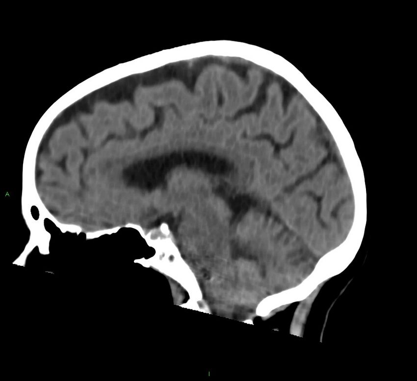 Cerebral amyloid angiopathy-associated lobar intracerebral hemorrhage (Radiopaedia 58757-65978 C 26).jpg