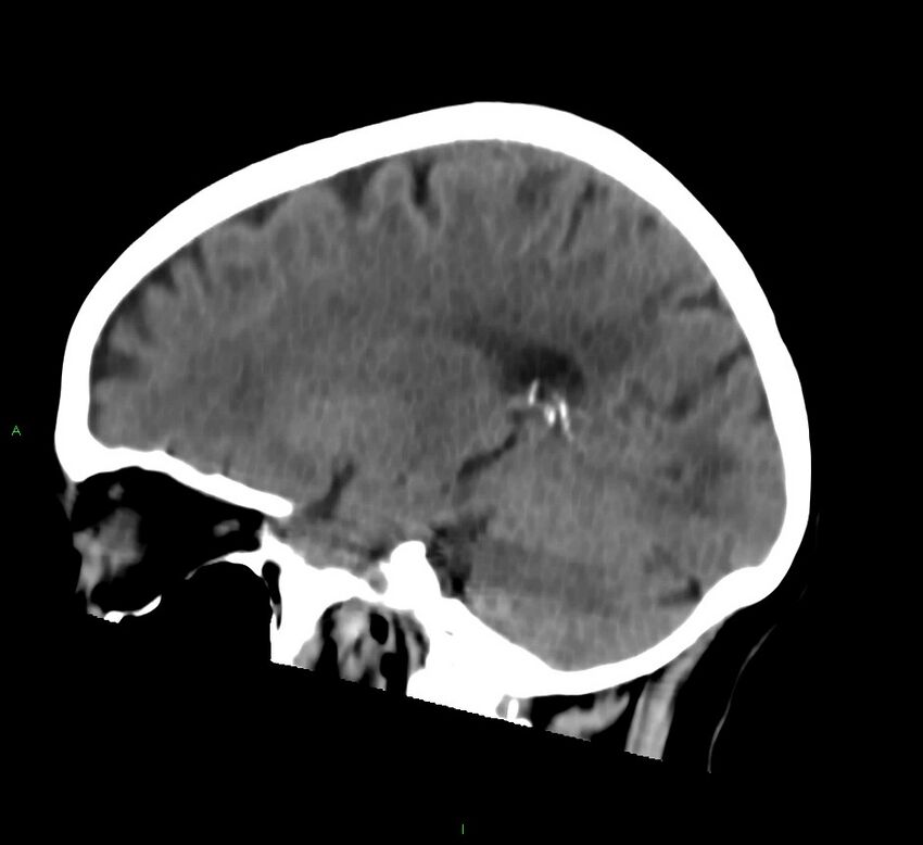 Cerebral amyloid angiopathy-associated lobar intracerebral hemorrhage (Radiopaedia 58757-65978 C 34).jpg