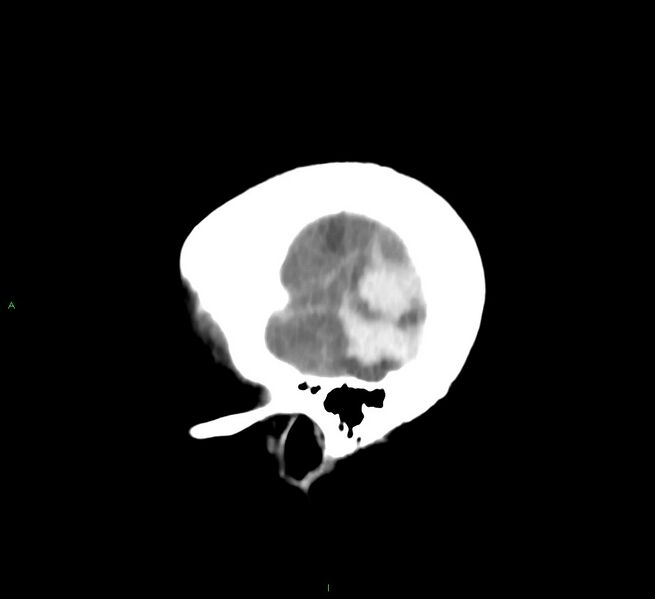 File:Cerebral amyloid angiopathy-associated lobar intracerebral hemorrhage (Radiopaedia 58757-65978 C 48).jpg