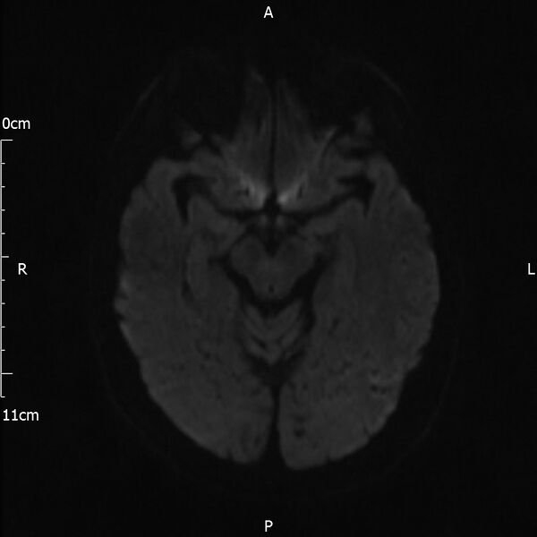 File:Cerebral amyloid angiopathy related inflammation (Radiopaedia 72772-83415 Axial DWI 56).jpg