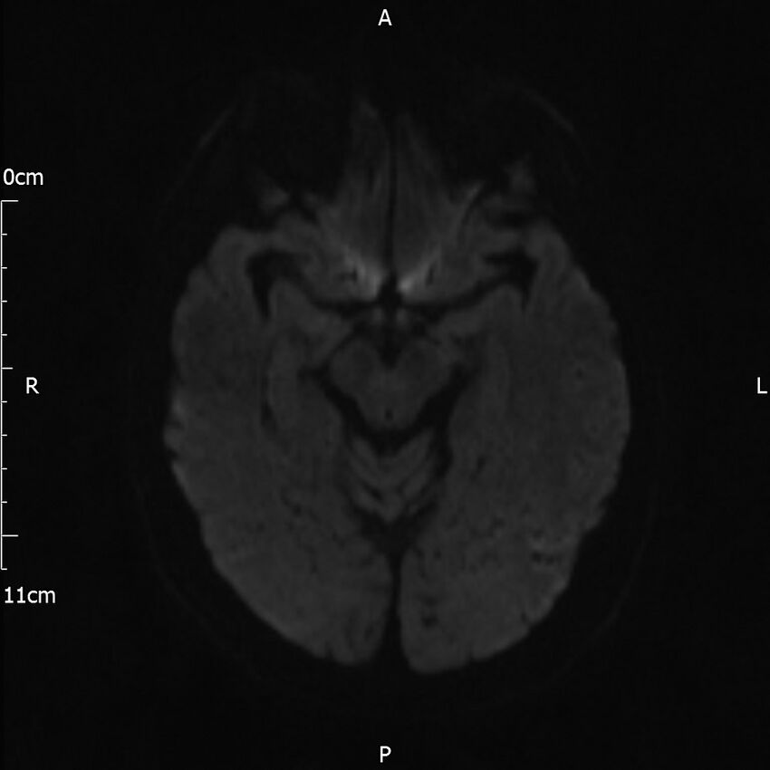 Cerebral amyloid angiopathy related inflammation (Radiopaedia 72772-83415 Axial DWI 56).jpg