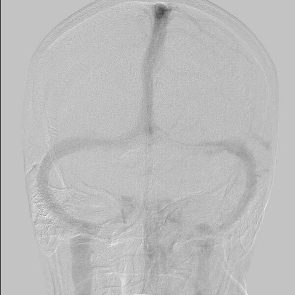 File:Cerebral aneurysm with rupture (Radiopaedia 29933-30458 LT CCA IC 24).jpg