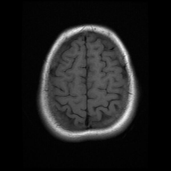 File:Cerebral cavernous malformation (Radiopaedia 44301-47942 Axial T1 18).jpg