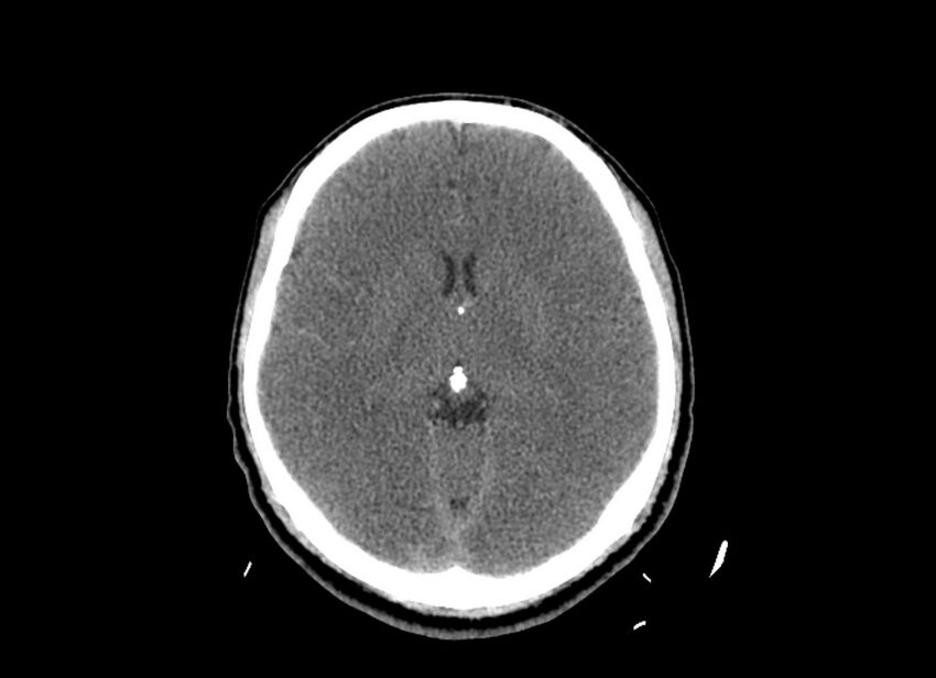 Cerebral edema (Radiopaedia 82519-96661 Axial non-contrast 28).jpg