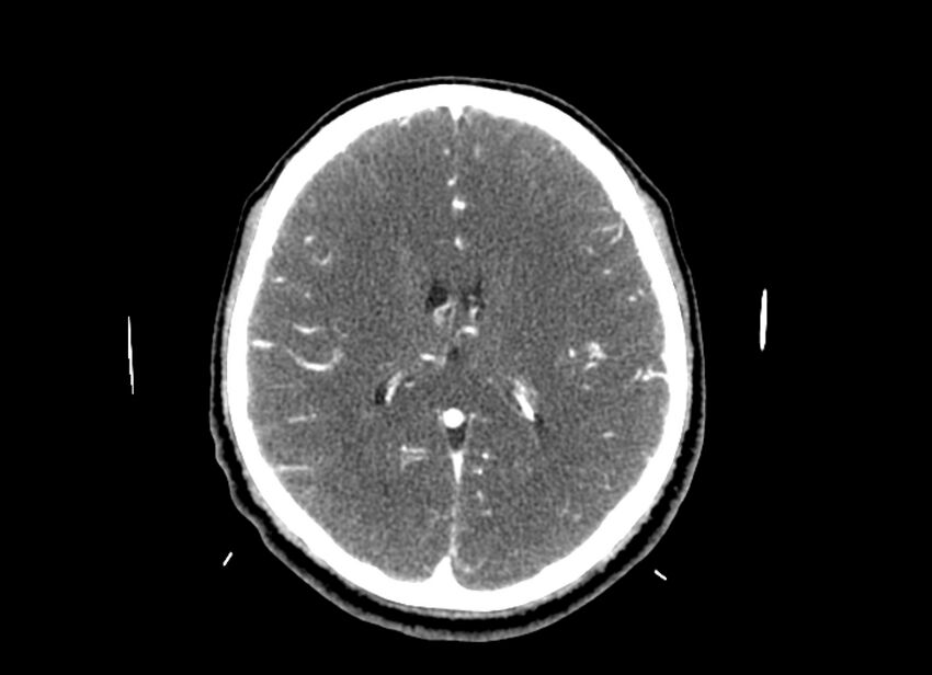 Cerebral edema (Radiopaedia 82519-96661 B 26).jpg