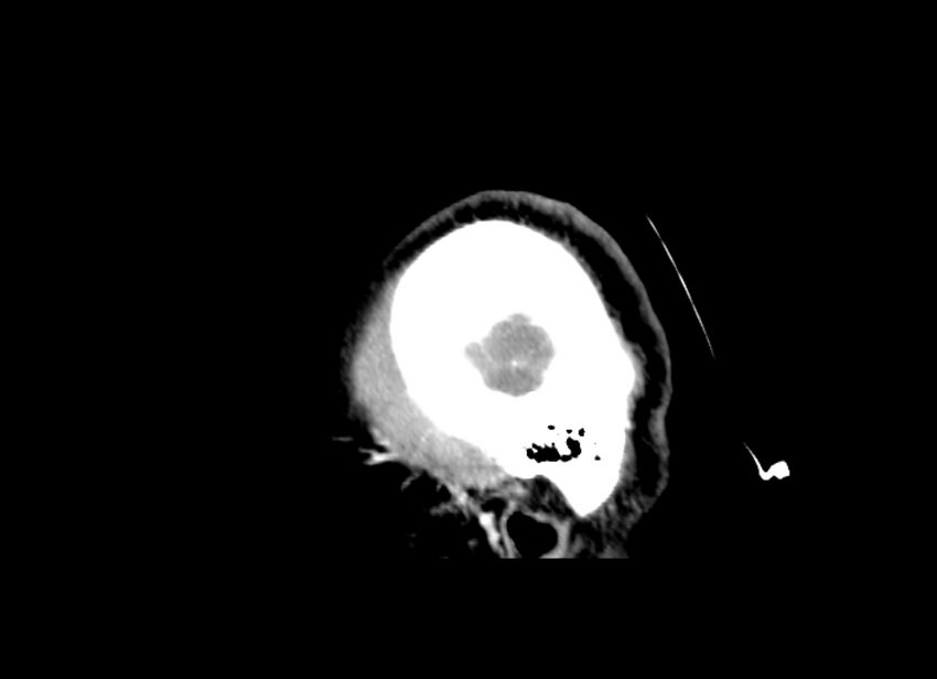 Cerebral edema (Radiopaedia 82519-96661 D 50).jpg