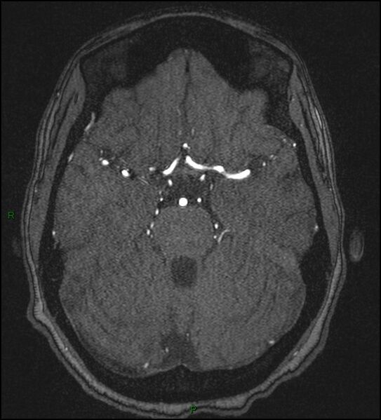 File:Cerebral fat embolism (Radiopaedia 35022-36525 Axial TOF 68).jpg