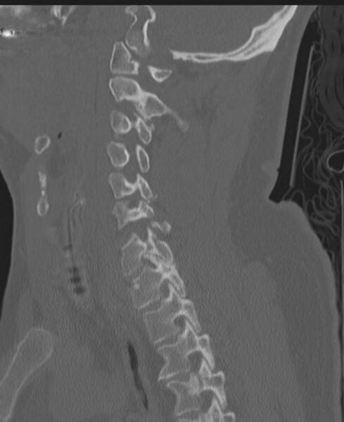 File:Cerebral hemorrhagic contusions and cervical spine fractures (Radiopaedia 32865-33841 Sagittal bone window 43).jpg