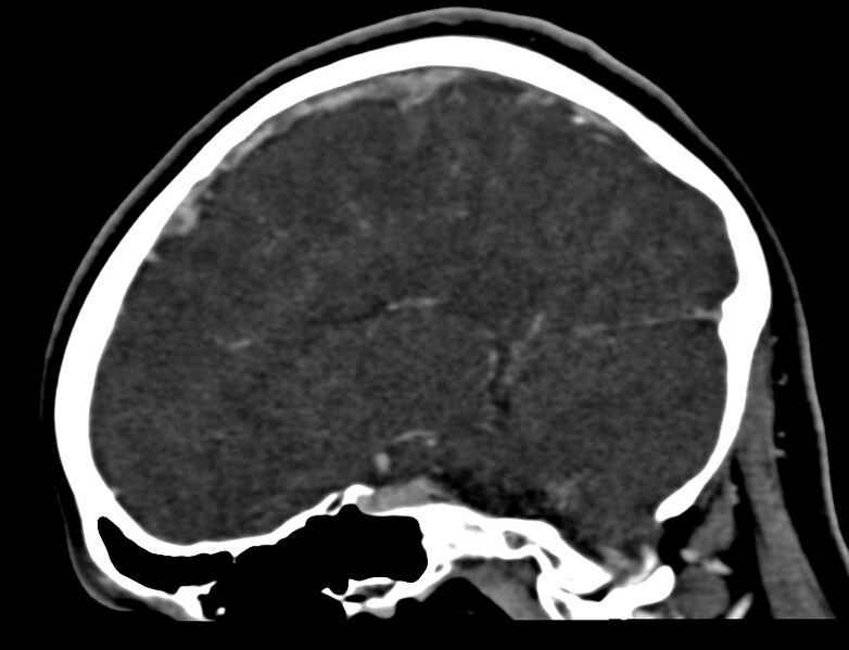 File:Cerebral venous sinus thrombosis (Radiopaedia 59224-66646 Sagittal C+ delayed 17).jpg