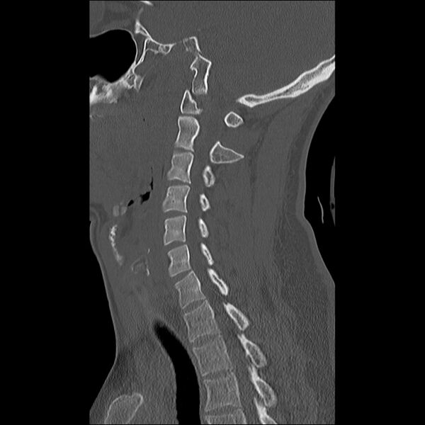 File:Cervical facet fracture and anterior discoligamentous injury (Radiopaedia 32139-33083 Sagittal bone window 14).jpg