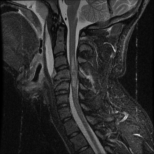File:Cervical flexion teardrop fracture with cord hemorrhage (Radiopaedia 32497-33455 Sagittal STIR 10).jpg