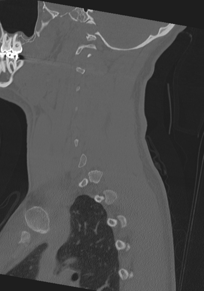 File:Cervical intercalary bone (Radiopaedia 35211-36748 Sagittal bone window 60).png
