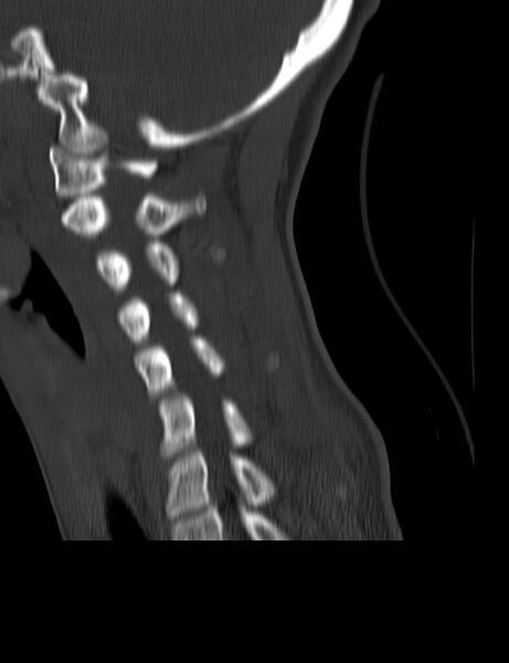File:Cervical spine posterior ligamentous complex rupture (Radiopaedia 63486-72101 Sagittal bone window 8).jpg