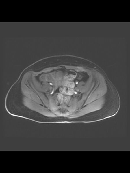 File:Cesarean section scar endometrioma (Radiopaedia 56569-63297 Axial T1 C+ fat sat 31).jpg