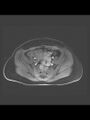Cesarean section scar endometrioma (Radiopaedia 56569-63297 Axial T1 C+ fat sat 31).jpg