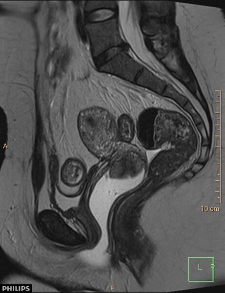 File:Cesarian scar endometriosis (Radiopaedia 68495-78066 Sagittal T2 14).jpg