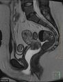 Cesarian scar endometriosis (Radiopaedia 68495-78066 Sagittal T2 14).jpg