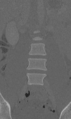 Chance fracture (Radiopaedia 40360-42912 Coronal bone window 18).png