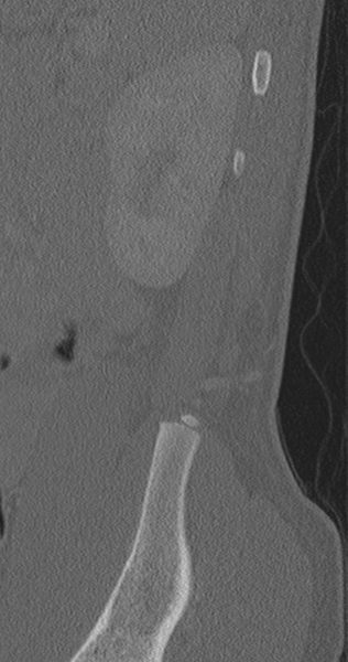 File:Chance fracture (Radiopaedia 40360-42912 Sagittal bone window 8).png