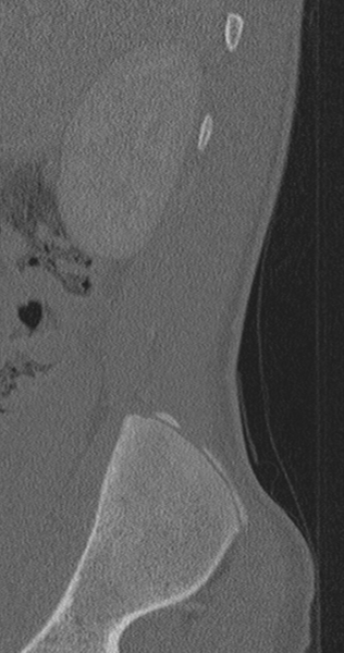 File:Chance fracture (Radiopaedia 40360-42912 Sagittal bone window 92).png