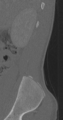 Chance fracture (Radiopaedia 40360-42912 Sagittal bone window 92).png